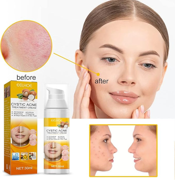 Eelhoe - Cystic Acne Cream (Original)